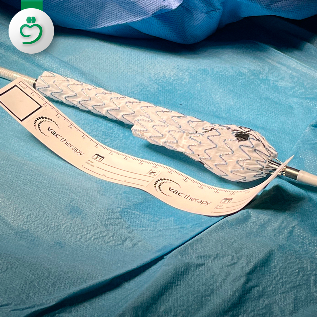 За първи път в България съдови хирурзи от „Софиямед“ спасиха мъж с аневризма на аортата чрез приложение на модифицирана еднопротеза