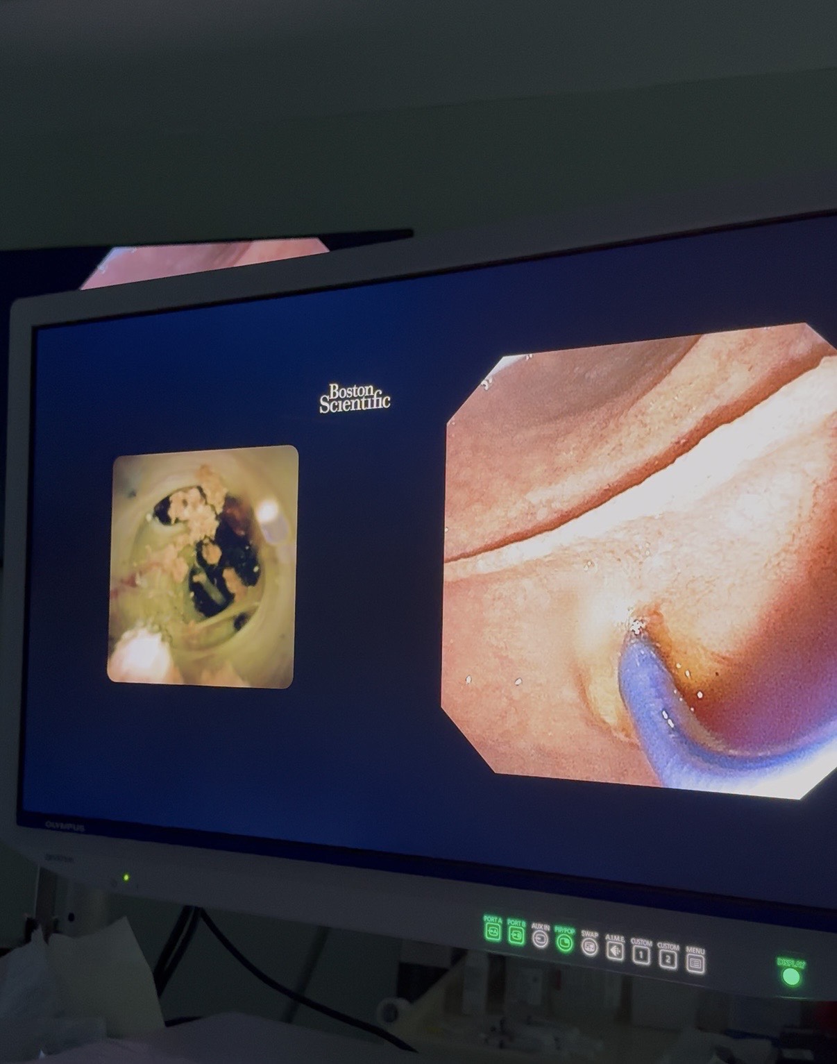 Холангиоскопия с електрохидравлична литотрипсия?