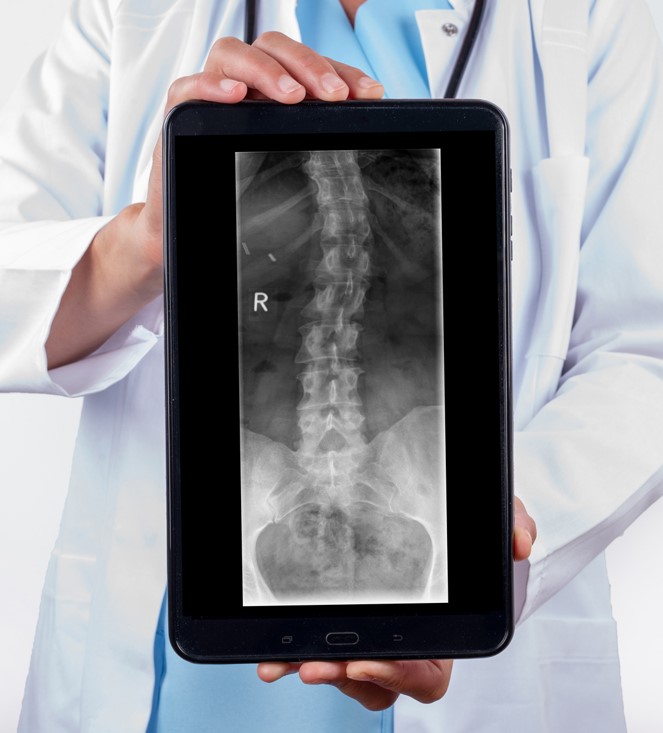 Д-р Симон Байерл:Не всяко изкривяване на гръбначния стълб е сколиоза