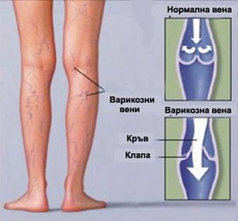 Безплатни прегледи за венозни заболявания в „Софиямед“ 